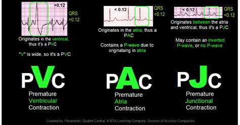 Watch an animation of a normal heartbeat. . Pac and pvc treatment